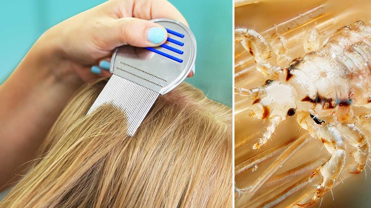 Head Lice In Children And Adults