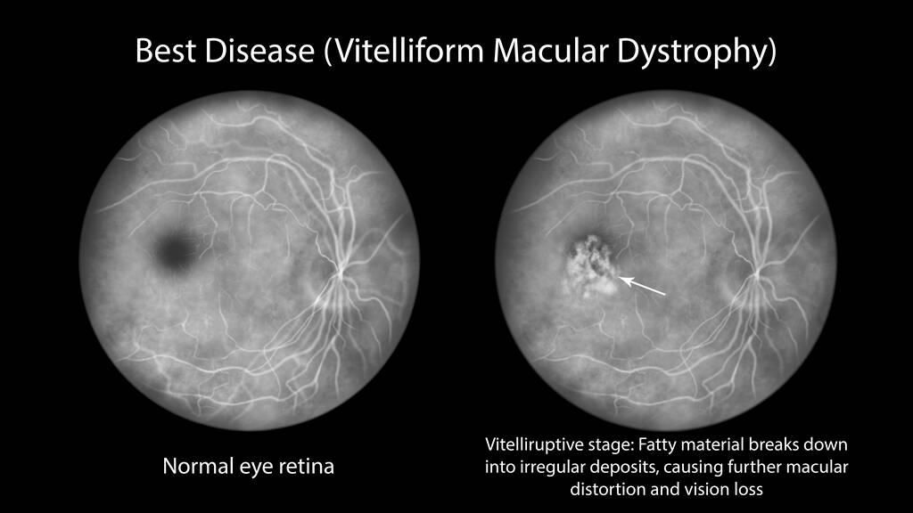 Diabetic Retinopathy Is An Eye Condition That Affects Eye Retina